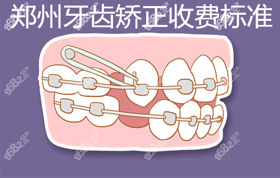 郑州牙齿矫正收费标准