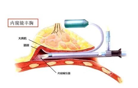 薛瑞做的隆胸手術怎么樣