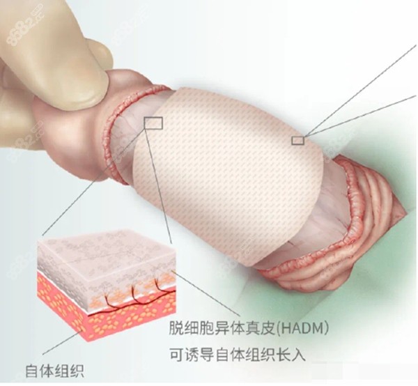 生物补片增粗前后对比