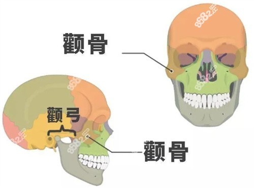 上海颧骨整形多少钱？