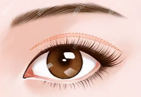 吳焱秋修復(fù)雙眼皮怎么樣