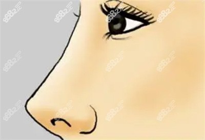 李希军医生隆鼻的技术优势2