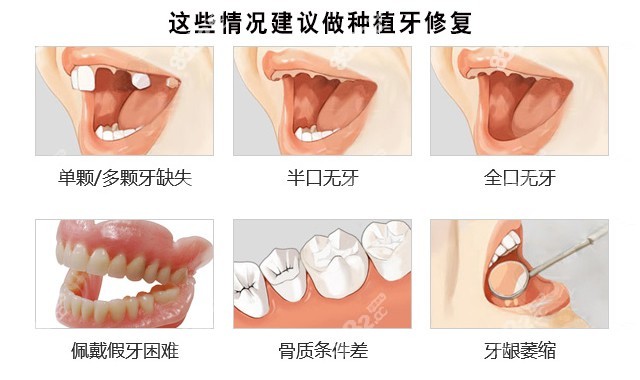 深圳罗湖区医院一颗种植牙多少钱