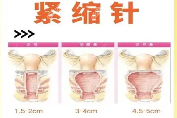 上海九龙医院私密整形紧缩针患者反馈