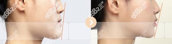 韩国必妩整形医院做长下巴截骨真人对比照m.8682.cc