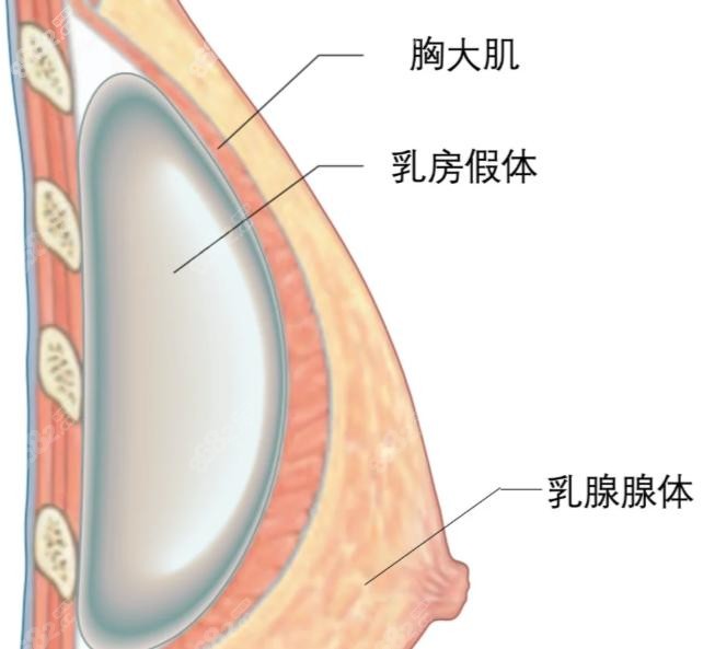 美波婷隆胸是不是骗人的