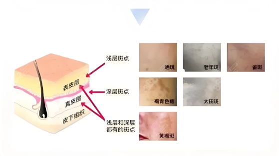 光子嫩肤