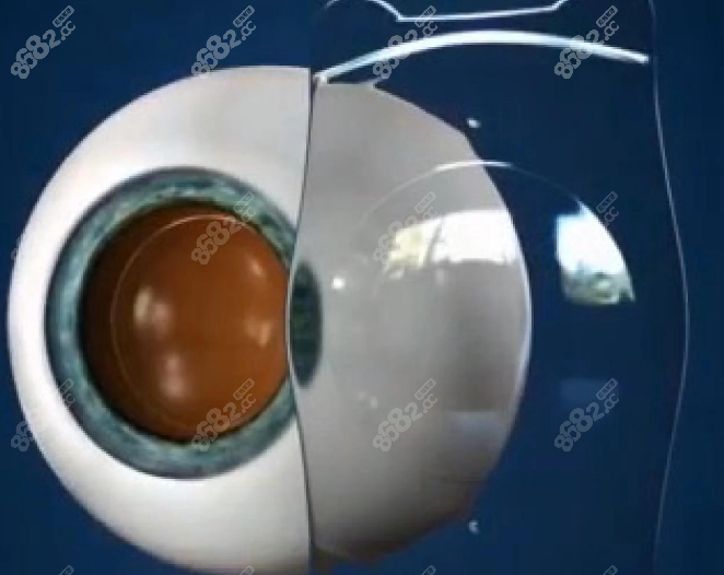 太原麥迪格眼科做晶體植入近視手術(shù)怎么樣 太原麥迪格眼科做晶體植入近視手術(shù)怎么樣