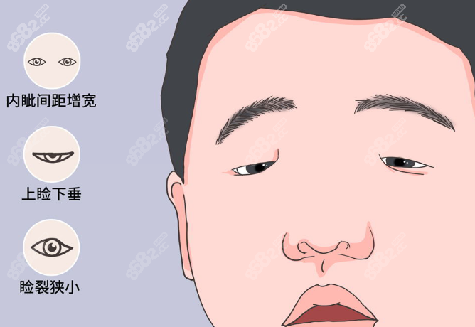 小睑裂综合征手术费用大概多少钱能报销吗？手术难度详解