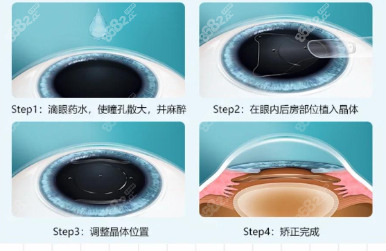 太原做晶體植入近視手術(shù)怎么選 太原做晶體植入近視手術(shù)怎么選