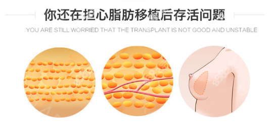 孙泽芳做自体脂肪丰胸存活率更高