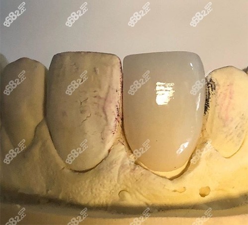 烤瓷牙冠内部颜色较深