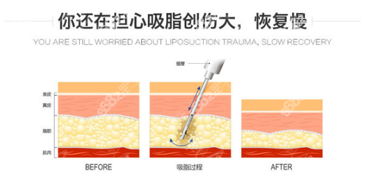 孙泽芳吸脂创伤小，恢复