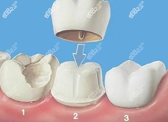 蕪湖美臣口腔牙冠價(jià)目表