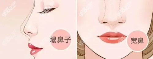 唐院长自创隆鼻技术一 唐院长自创隆鼻技术一