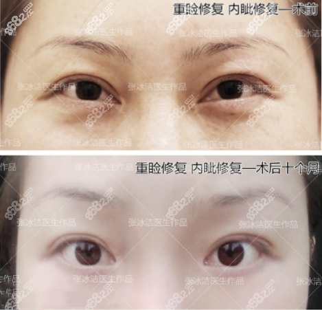 北京克莱美舍张冰洁眼修复案例对比图