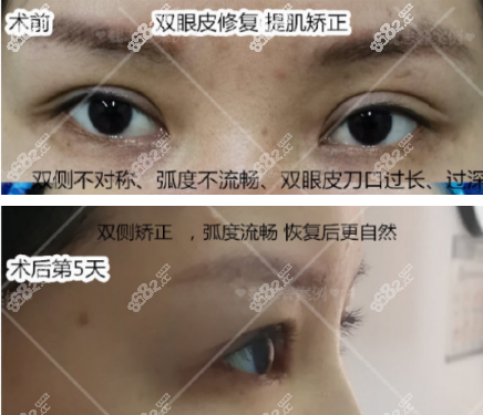 北京丽星翼美魏志香双眼皮修复案例对比图