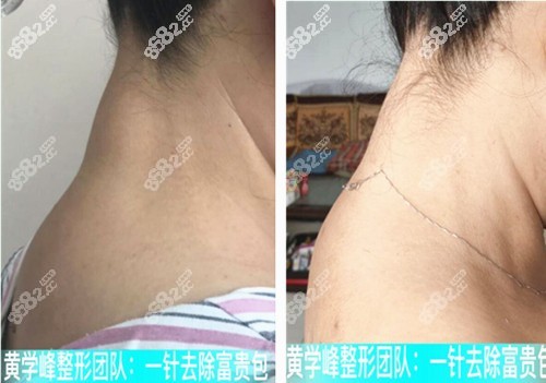 黄学峰一针去除富贵包术前术后对比