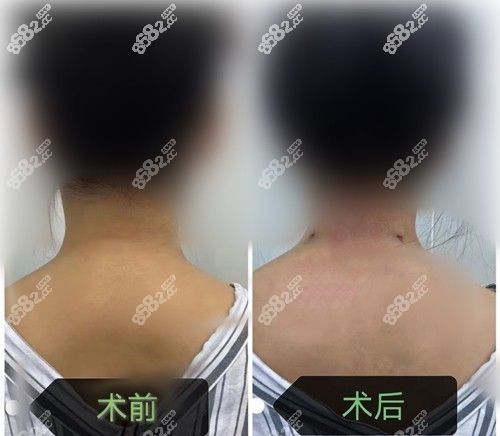 黄学峰一针去除富贵包真人图片