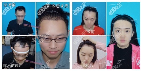 深圳<!--<i data=20240705-sp></i>-->发际线种植实例前后效果对比图