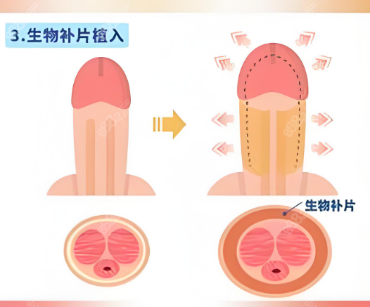 延长增粗