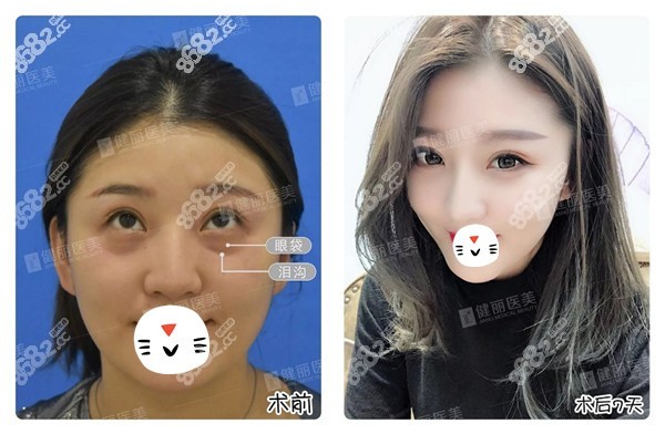 王科学医生做不开刀祛眼袋对比图