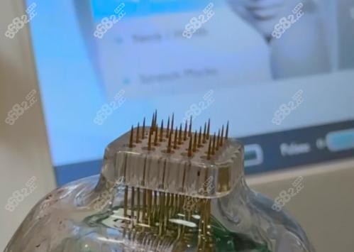 为什么黄金微针值得做