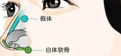 济南艺星薛提朋做鼻子