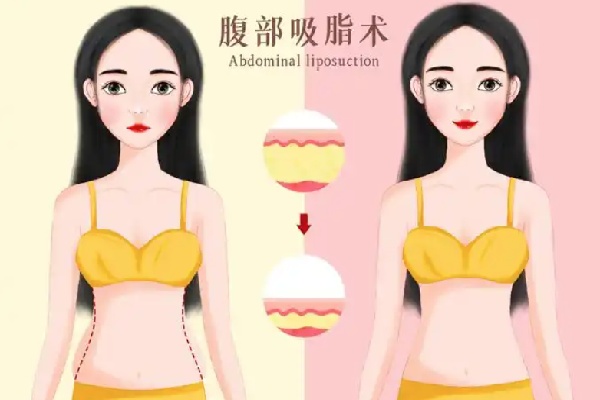 十堰亚美达吸脂塑形怎么样?日韩技术+职业医生团队打造身材
