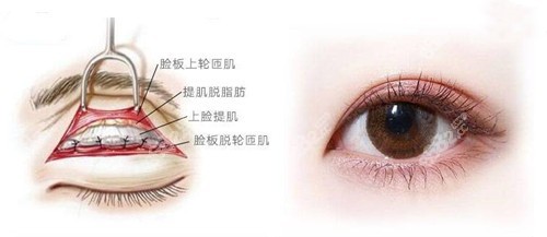 武汉项利姣双眼皮修复技术比较好