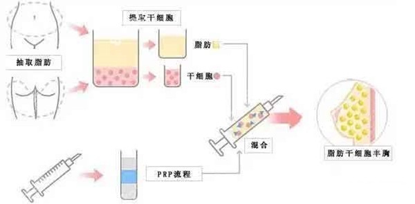 <!--<i data=20240705-sp></i>-->脂肪隆胸怎么樣？