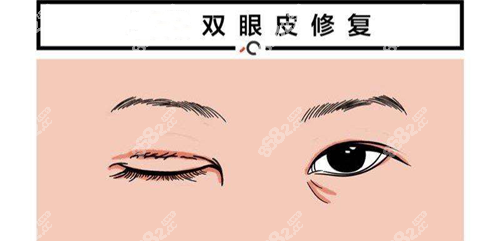 武汉双眼皮修复医生排名前十公布