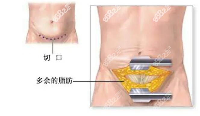 整形手術(shù)示意圖ekelt.cn