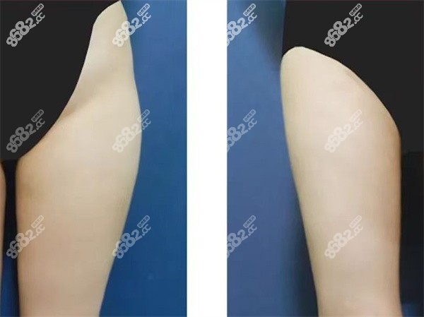 王明利医生做吸脂怎么样