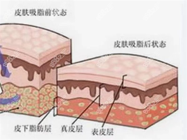 王明利医生做吸脂怎么样