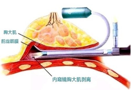 内窥镜乳房缩小手术技术图