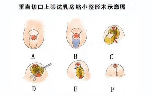 www.8682.cc提供的乳房缩小手术图解