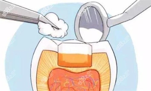 口腔科根管治疗