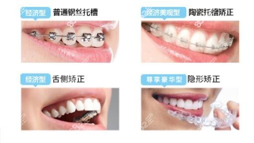 玉林蓝天口腔牙齿矫正价格表