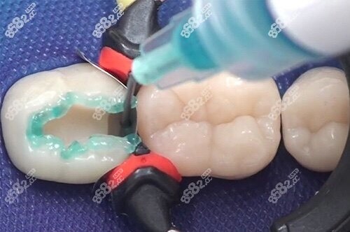 口腔科补牙
