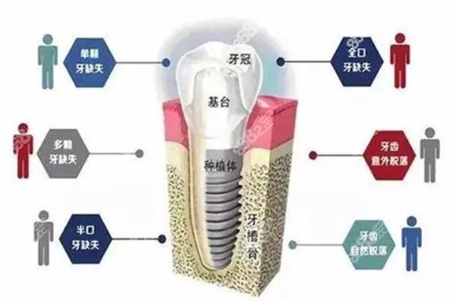 玉林蓝天口腔种植牙价格表