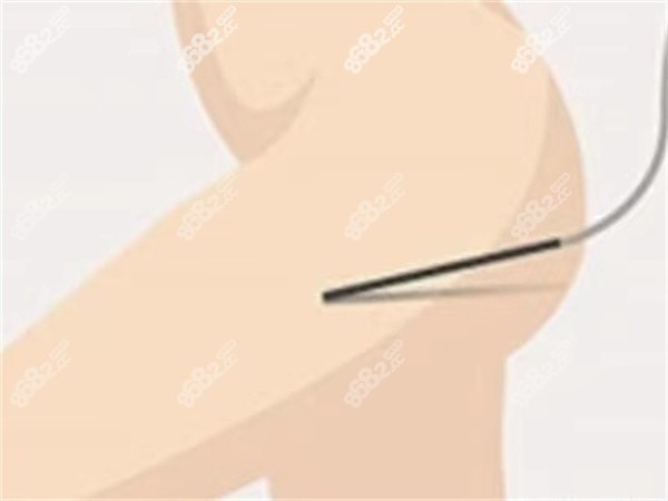 王明利医生做吸脂怎么样