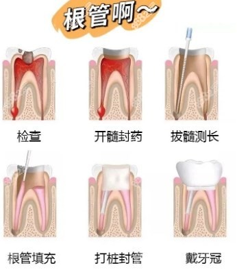 根管治疗步骤