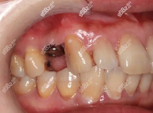 后磨牙缺失怎么修复比较好