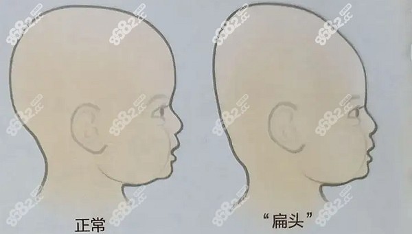 韓國雕刻整形醫(yī)院后腦勺填充價格