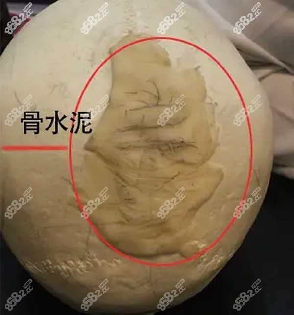 韓國雕刻整形醫(yī)院后腦勺填充骨水泥的優(yōu)勢