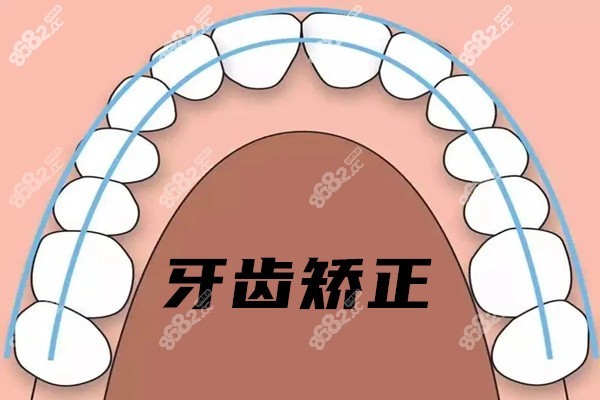 美国Damon跟AO自锁托槽的区别