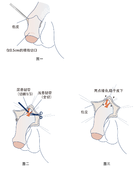 阴茎持久延长不回缩