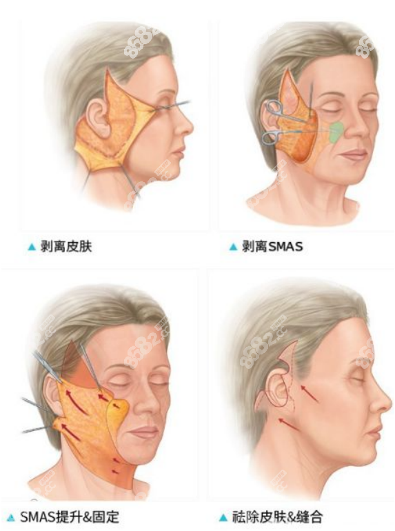 面部大拉皮手术