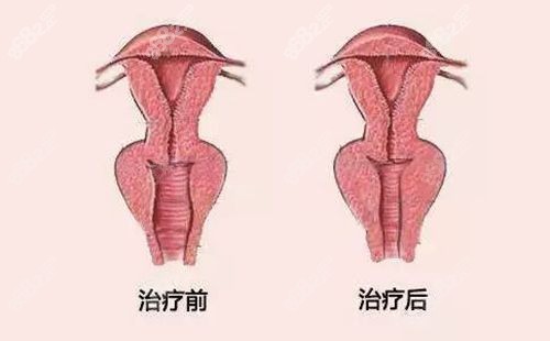 蒙娜丽莎之吻的成效